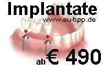 ZAHN-Behandlung in CZ -günstiger als Ungarn- Implantate 490 Euro