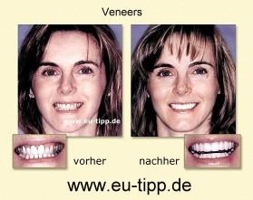 Zahn-Reise nach CZ - Euro 179 all inclusive - Implantate Euro 490