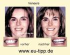 ZAHN-Reise CZ -günstiger als Ungarn- Implantate ab 490 Euro